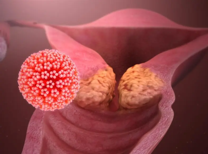 Les Principales Causes d'un Frottis Inflammatoire diagnostic d'une inflammation au niveau du col de l'utérus causée par le HPV