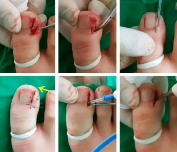 Principales techniques chirurgicales pour le traitement de l'ongle incarné techniques chirurgicales pour ongle incarné au pied