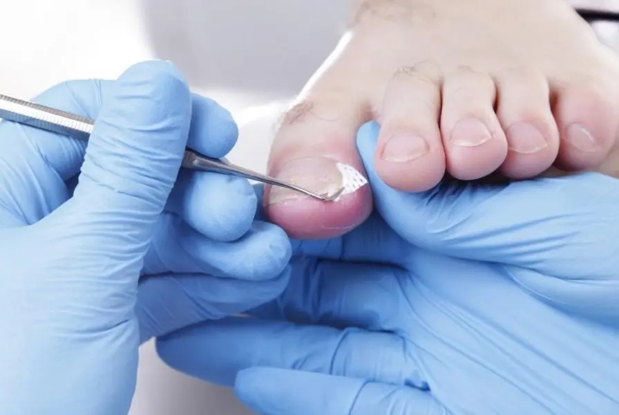 Guide visuel de prévention de l'ongle incarné : bonnes pratiques au quotidien techniques de prévention de l'ongle incarné au pied