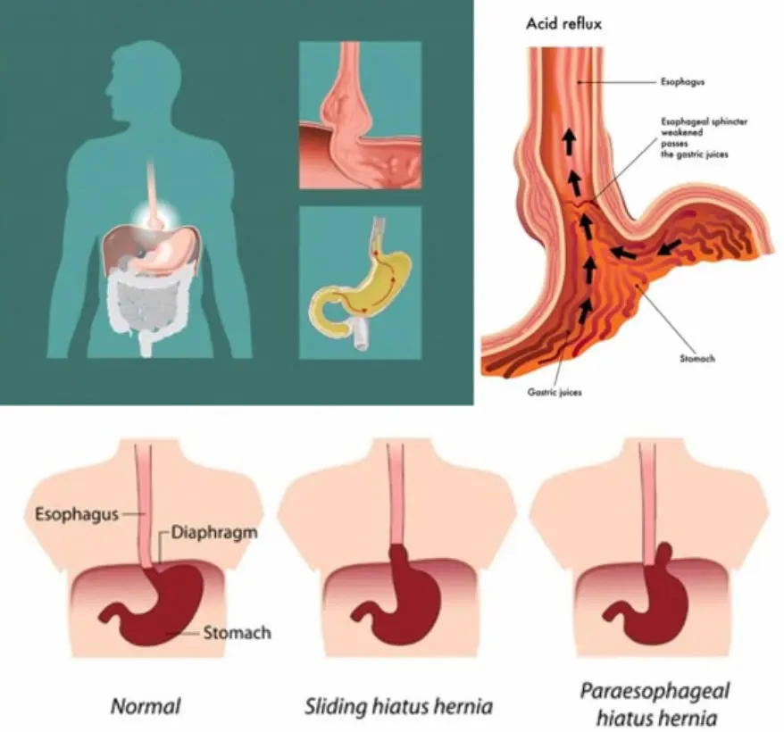 Schéma du reflux gastro-œsophagien montrant la remontée des acides vers la gorge