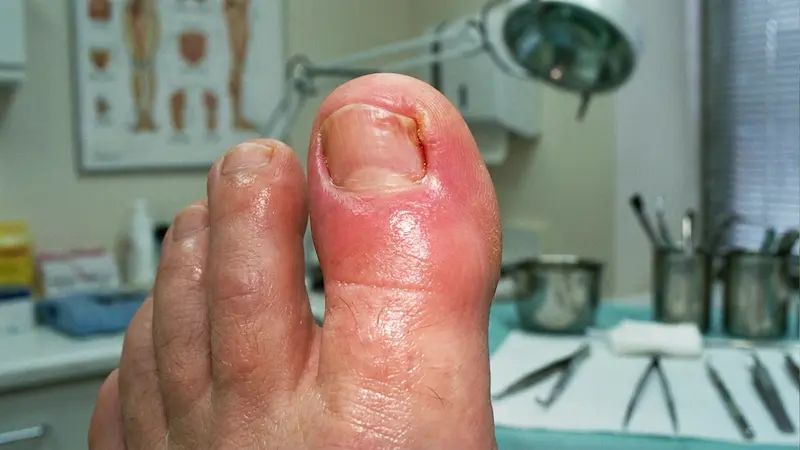 Une rougeur localisée et un gonflement du sillon de l'orteil sont les premiers signes d'alerte à ne pas ignorer Gros orteil rouge et gonflé montrant les premiers signes d'un ongle incarné du pied inflammé débutant
